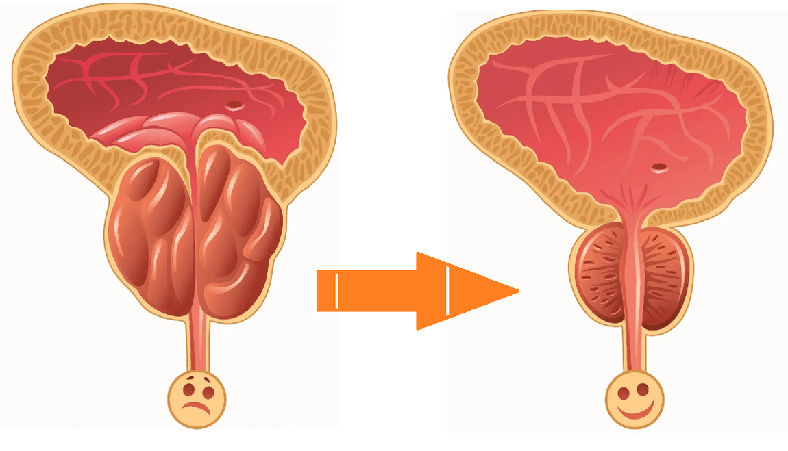Uromexil Forte Darbība uz prostatu ar prostatītu un adenomu
