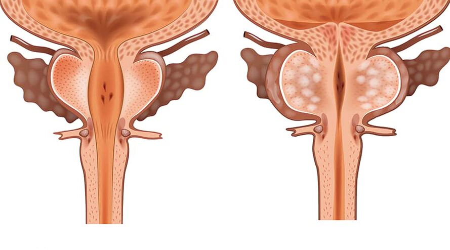 veselīgas un iekaisušas adenomas salīdzinājums