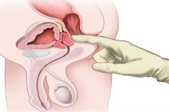 Prostatas masāža hroniska prostatīta ārstēšanai
