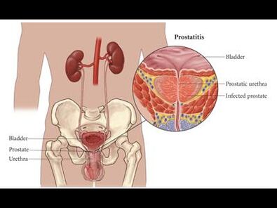 Prostatīts - prostatas dziedzera iekaisums