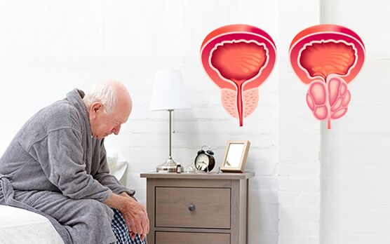 prostatīts vīriešiem